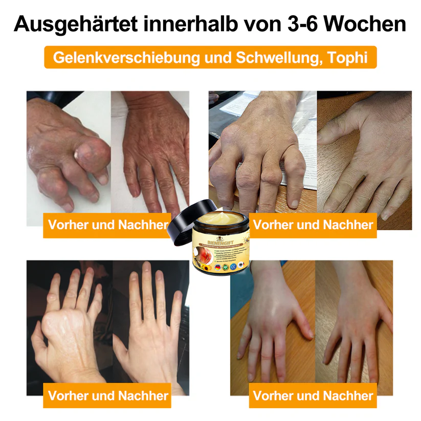 ✅ Offizieller Shop: flysmus™ Bienengift-Schmerzlinderungs Knochenheilungs Creme 👨‍⚕️Zertifiziert von der Bundesinstitut für Arzneimittel und Medizinprodukte (BfArM)