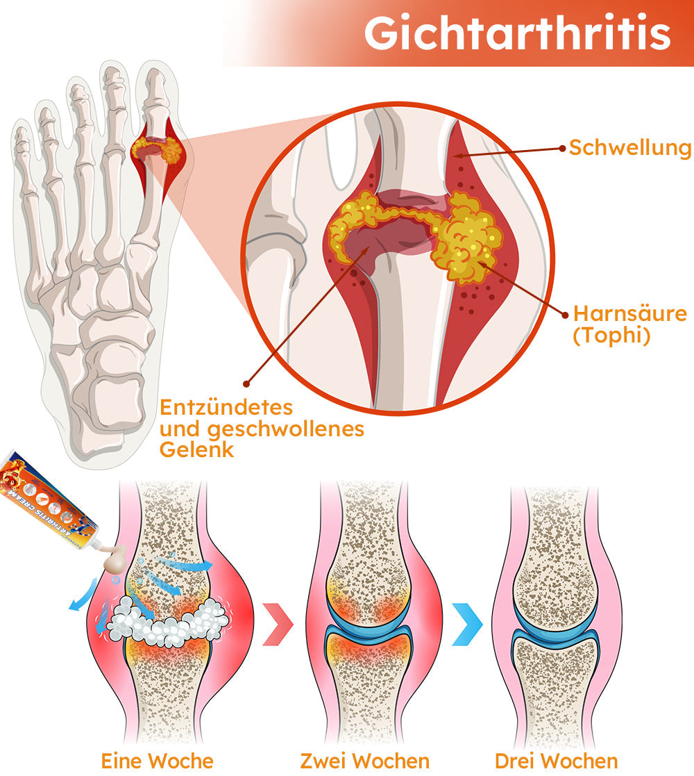 Furzero™ Arthritis Creme (Nacken & Zurück & Knie-Relief)