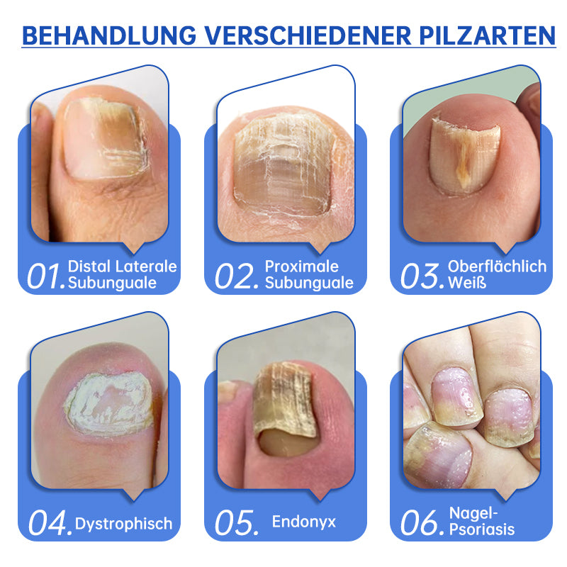 Furzero™ Pure-Nail Pilz-Lasertherapiegerät