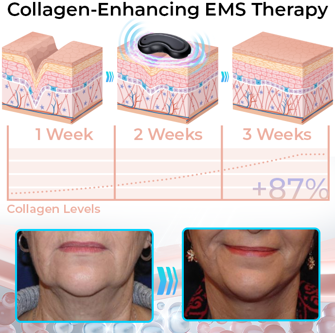 GFOUK™ EMSculpt Schlafendes V-Gesicht Schönheitsgerät